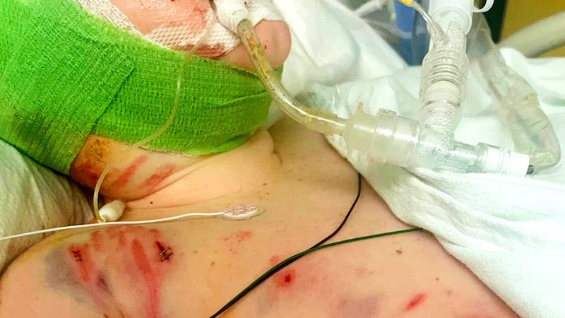 11-year-old survivor of 3-dog attack in Columbia County continues through surgeries