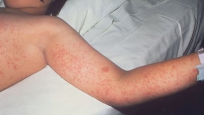 Health officials are raising awareness about the dangers of Measles after a child in Texas...