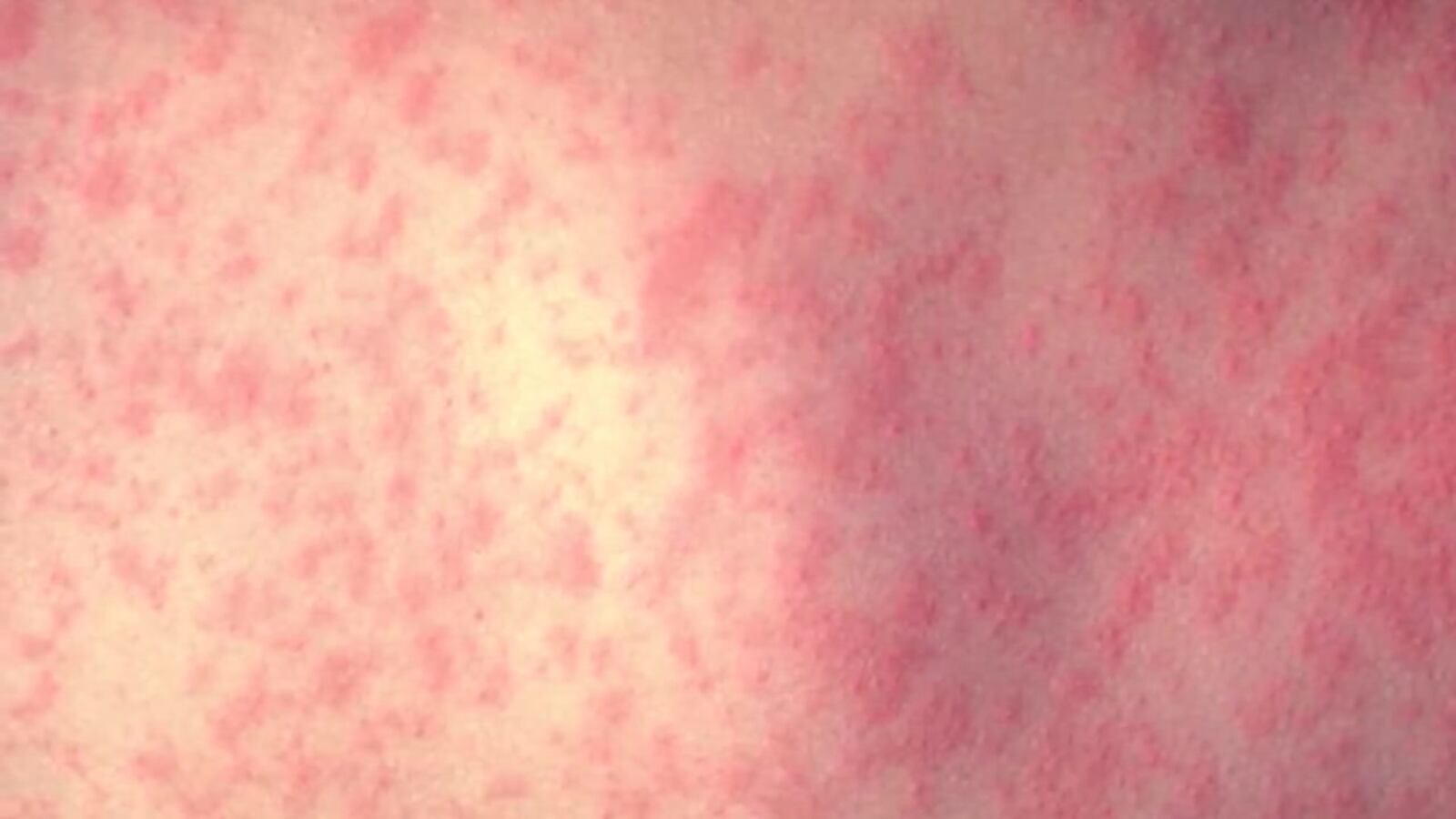 Rsv Rashes Flu, RSV cases rising ahead of holiday: What parents should know