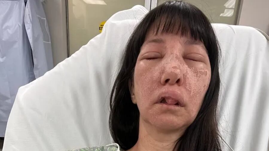 Jessica Rogue was hospitalized after being bit by multiple brown recluse spiders.